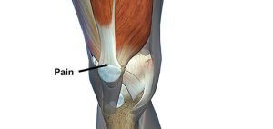 best quadriceps tendonitis exercises